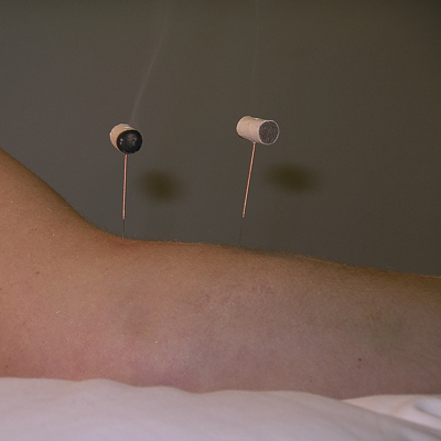 Moxibustion for Acupuncture